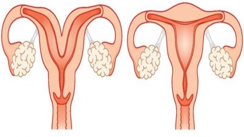 Mổ lấy thai an toàn cho sản phụ có 2 tử cung hiếm gặp