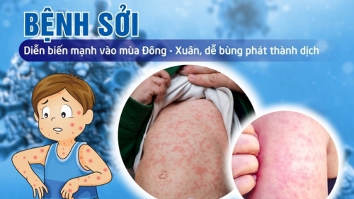 Thủ tướng yêu cầu tăng cường công tác phòng, chống bệnh sởi